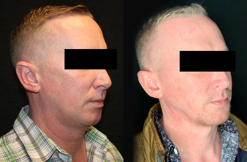 Patient #32637: FaceTite with Liposuction & Morpheus Combine Image