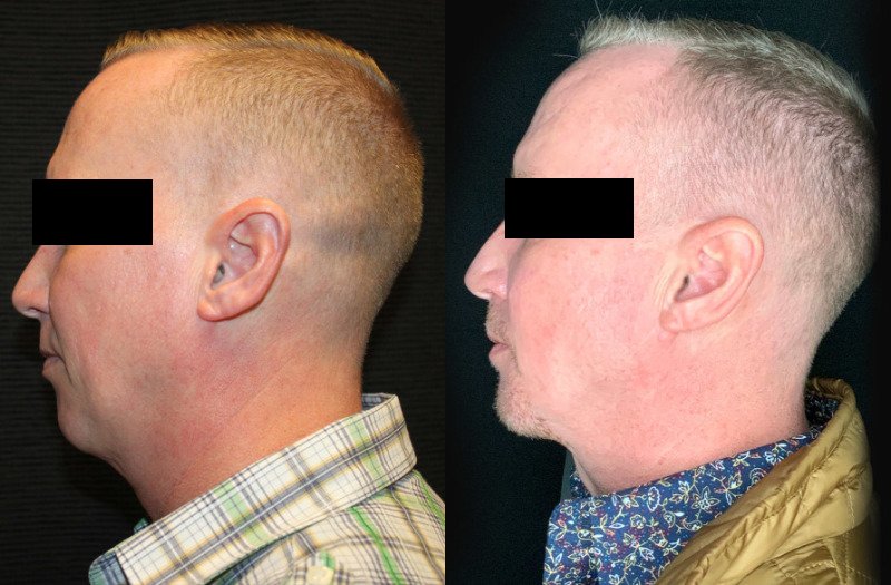 Patient #32637: FaceTite with Liposuction & Morpheus Combine Image