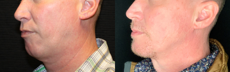 Patient #32637: FaceTite with Liposuction & Morpheus Combine Image