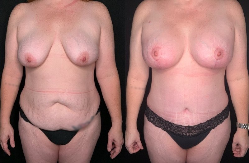 Patient #54677: Mommy Makeover Combine Image