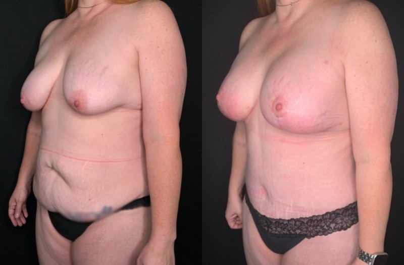 Patient #54677: Mommy Makeover Combine Image
