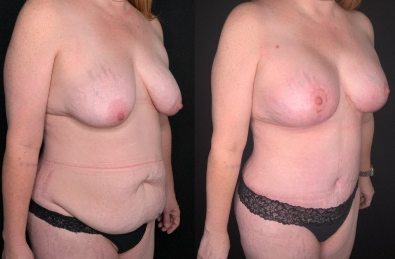 Patient #54677: Mommy Makeover Combine Image