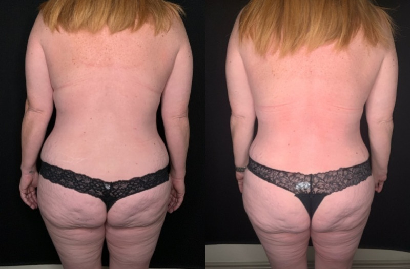 Patient #54677: Mommy Makeover Combine Image