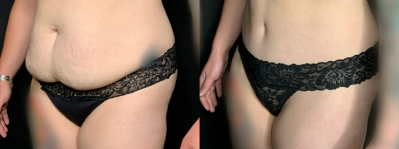 Patient #69725: Tummy Tuck with Liposuction to Flanks Combine Image