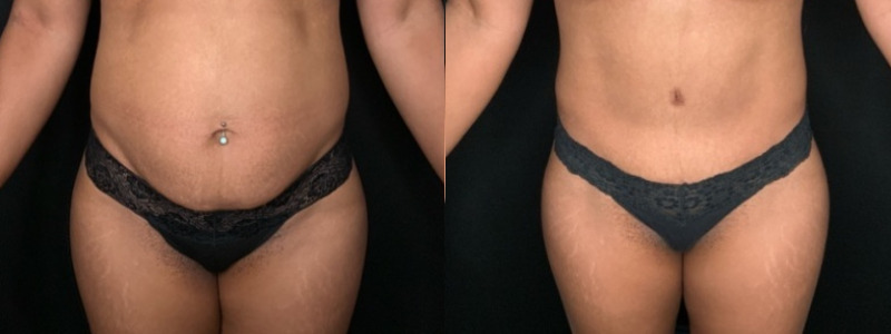 Patient #68942: Tummy Tuck Combine Image