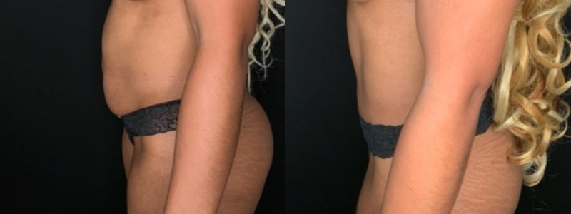 Patient #68942: Tummy Tuck Combine Image
