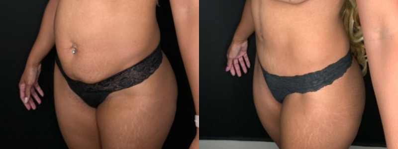 Patient #68942: Tummy Tuck Combine Image