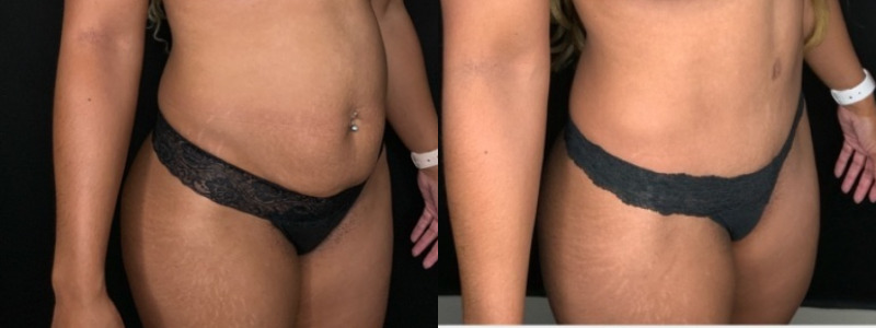Patient #68942: Tummy Tuck Combine Image