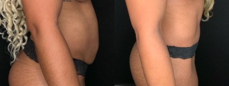 Patient #68942: Tummy Tuck Combine Image