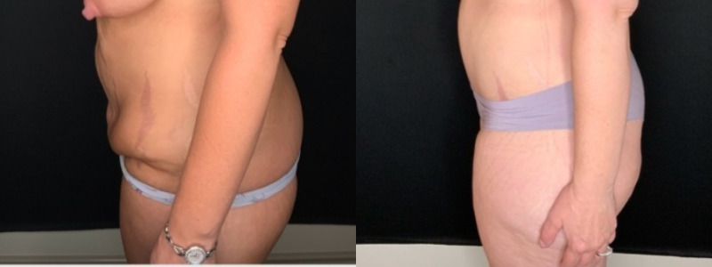 Patient #35811: Tummy Tuck with Liposuction to Flanks and Back Combine Image