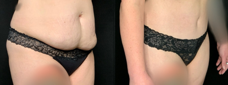 Patient #69725: Tummy Tuck with Liposuction to Flanks Combine Image