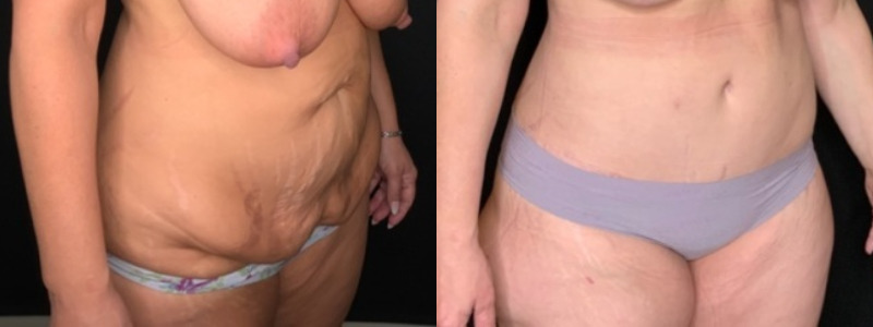 Patient #35811: Tummy Tuck with Liposuction to Flanks and Back Combine Image