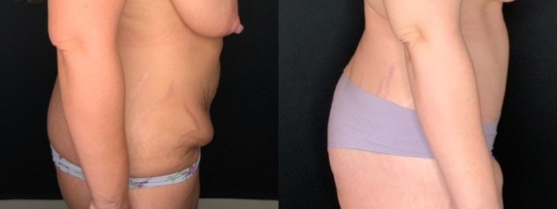 Patient #35811: Tummy Tuck with Liposuction to Flanks and Back Combine Image