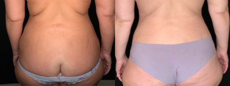 Patient #35811: Tummy Tuck with Liposuction to Flanks and Back Combine Image
