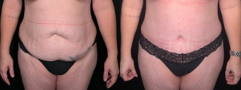 Patient #54677: Tummy Tuck with Liposuction to Flanks and Back Combine Image