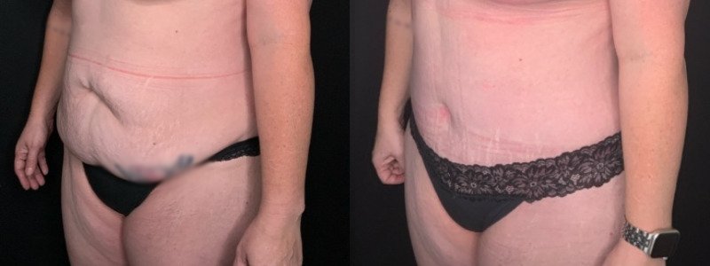 Patient #54677: Tummy Tuck with Liposuction to Flanks and Back Combine Image