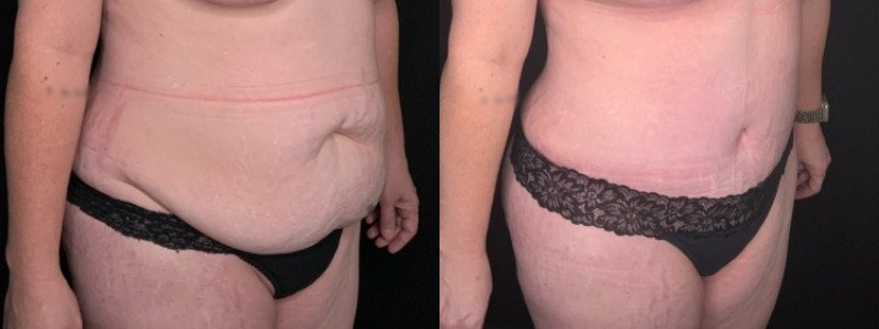 Patient #54677: Tummy Tuck with Liposuction to Flanks and Back Combine Image