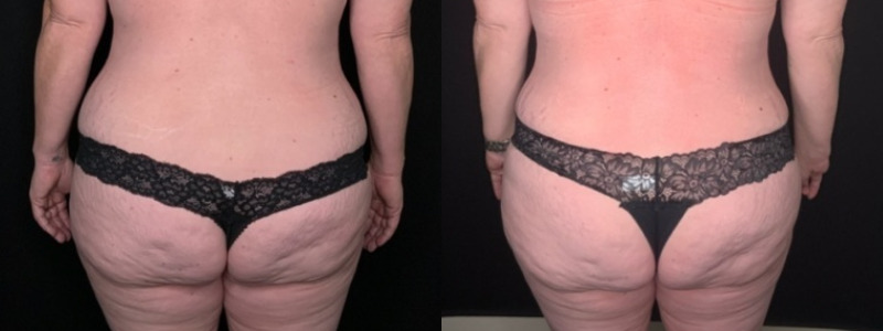 Patient #54677: Tummy Tuck with Liposuction to Flanks and Back Combine Image