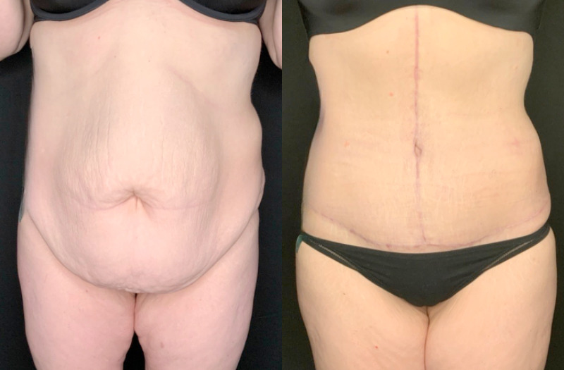 Patient #36478: Fleur-de-Lis Tummy Tuck Combine Image