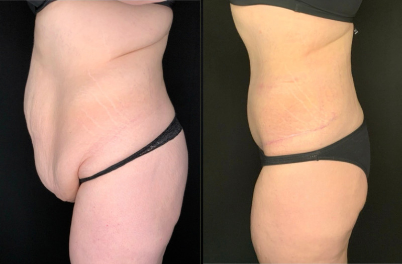 Patient #36478: Fleur-de-Lis Tummy Tuck Combine Image