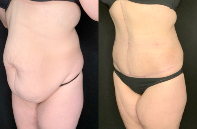 Patient #36478: Fleur-de-Lis Tummy Tuck Combine Image