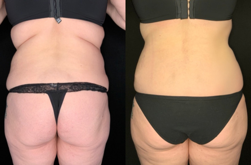 Patient #36478: Fleur-de-Lis Tummy Tuck Combine Image
