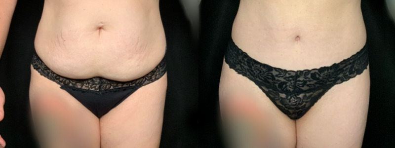 Patient #69725: Tummy Tuck with Liposuction to Flanks Combine Image