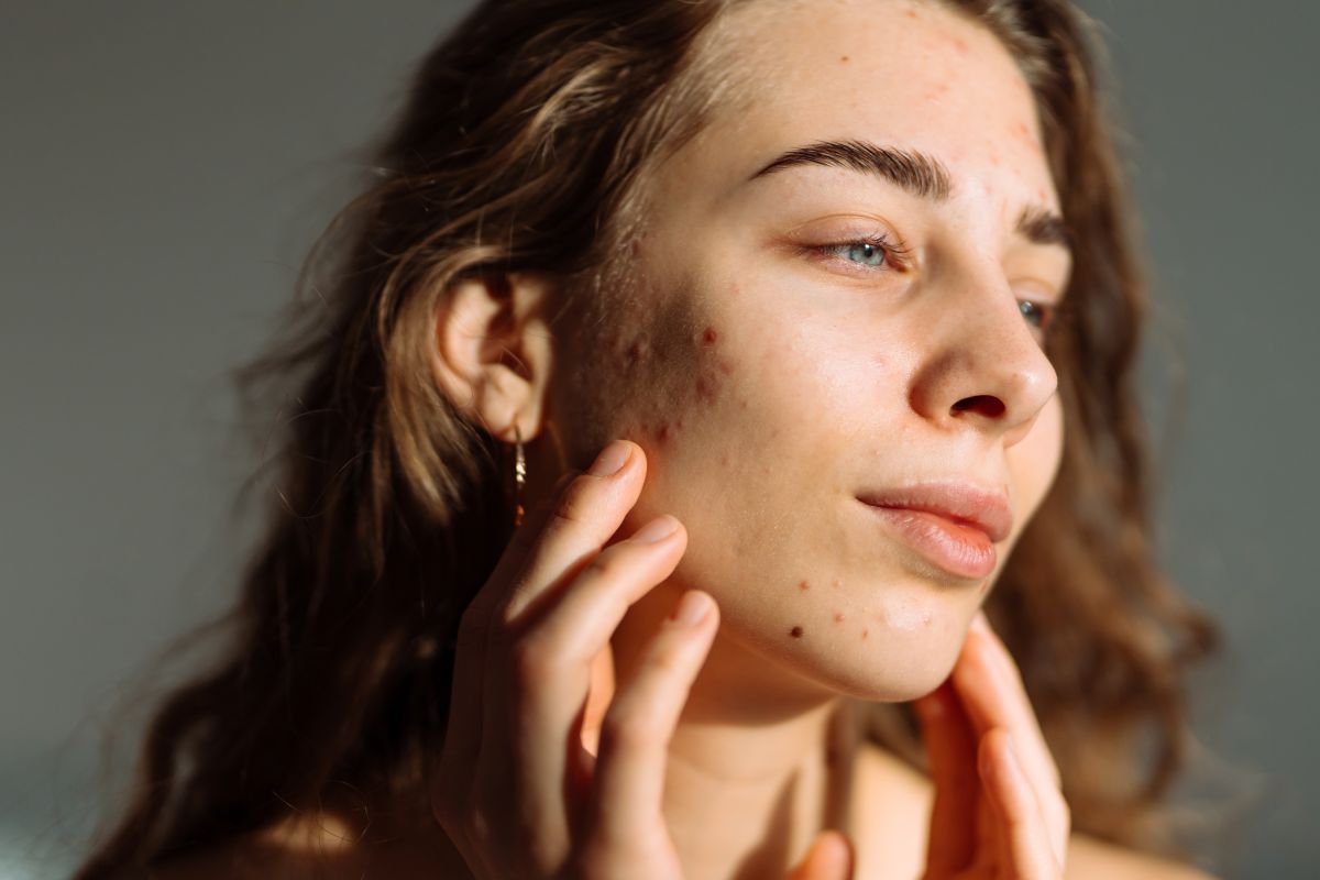 The 4 Types of Rosacea and How They are Treated Image