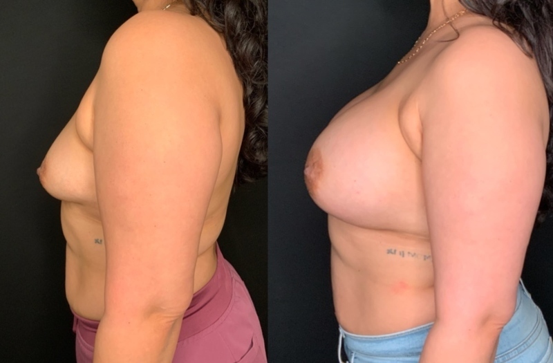 Patient #21795: Breast Augmentation Combine Image