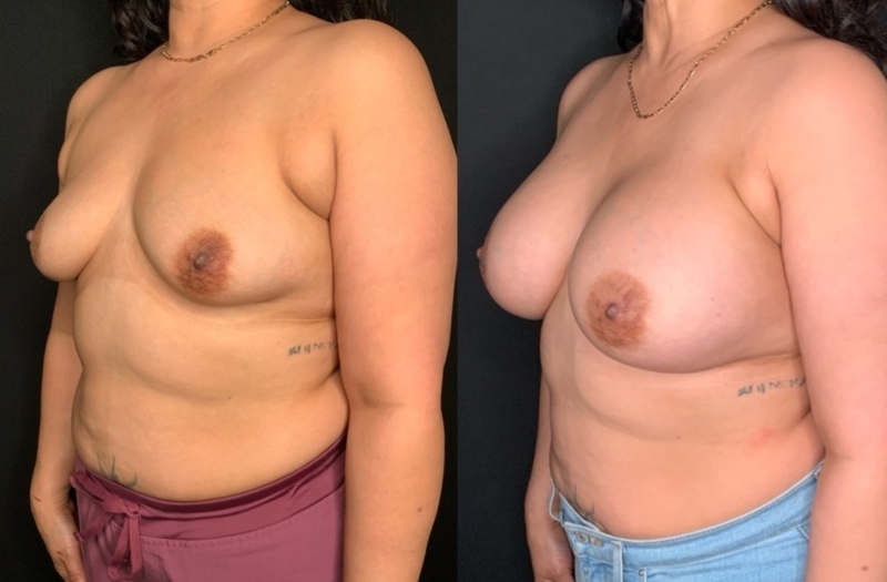 Patient #21795: Breast Augmentation Combine Image