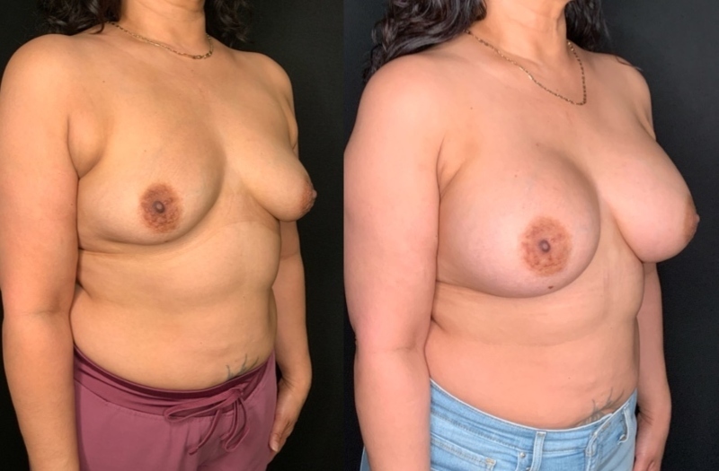Patient #21795: Breast Augmentation Combine Image