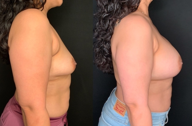 Patient #21795: Breast Augmentation Combine Image