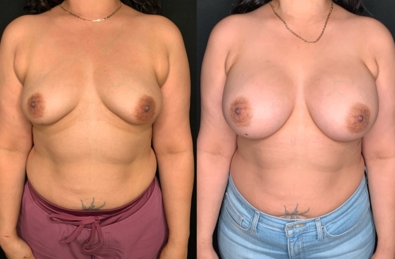 Patient #21795: Breast Augmentation Combine Image