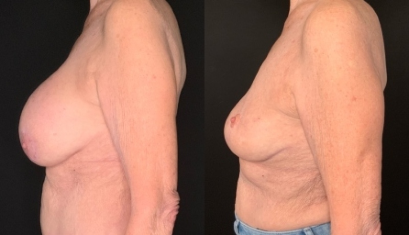 Patient #67948: Breast Implant Removal with Lift and Capsulectomy Combine Image
