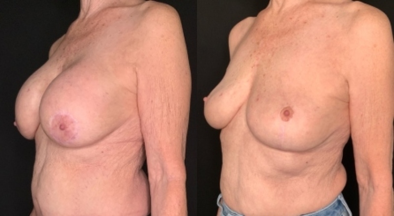 Patient #67948: Breast Implant Removal with Lift and Capsulectomy Combine Image