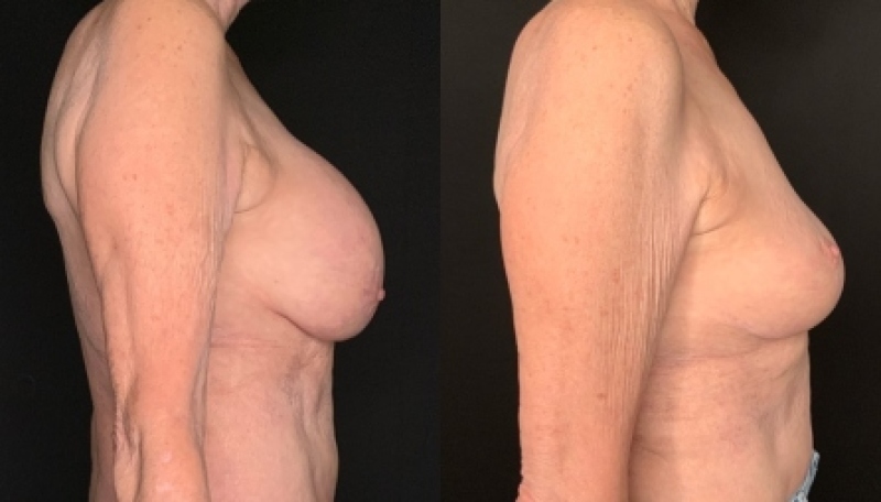 Patient #67948: Breast Implant Removal with Lift and Capsulectomy Combine Image