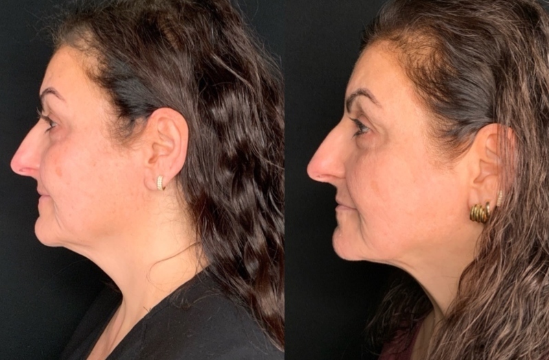 Patient #92544: FaceTite with Morpheus and CO2 Resurfacing Combine Image