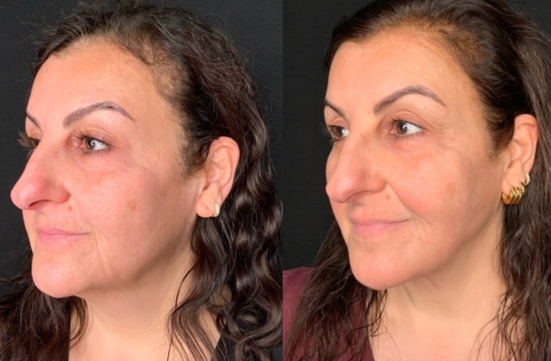 Patient #92544: FaceTite with Morpheus and CO2 Resurfacing Combine Image