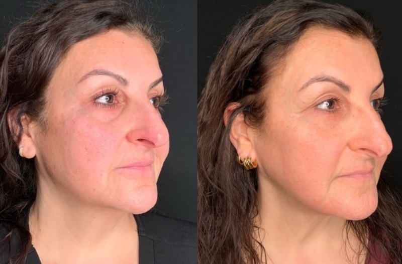 Patient #92544: FaceTite with Morpheus and CO2 Resurfacing Combine Image