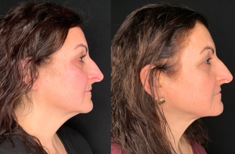Patient #92544: FaceTite with Morpheus and CO2 Resurfacing Combine Image