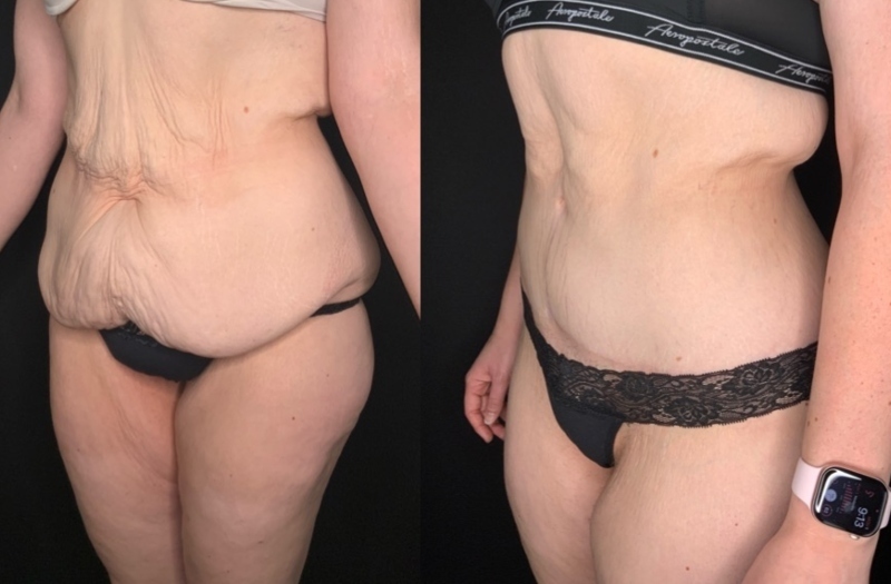 Patient #62578: Fleur-de-Lis Tummy Tuck with Liposuction Combine Image