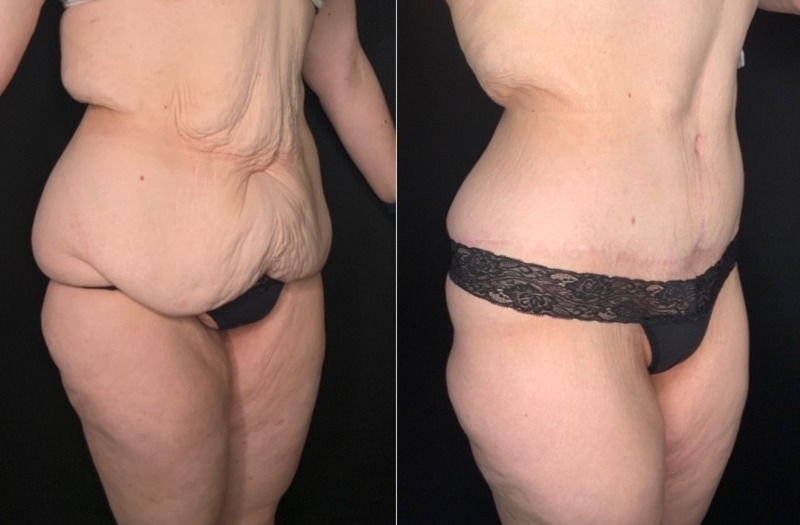 Patient #62578: Fleur-de-Lis Tummy Tuck with Liposuction Combine Image