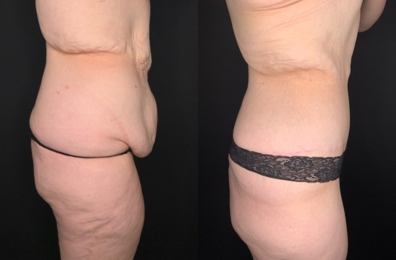 Patient #62578: Fleur-de-Lis Tummy Tuck with Liposuction Combine Image