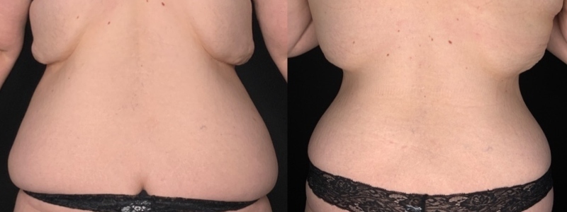 Patient #62578: Fleur-de-Lis Tummy Tuck with Liposuction Combine Image