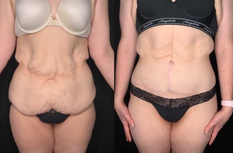 Patient #62578: Fleur-de-Lis Tummy Tuck with Liposuction Combine Image