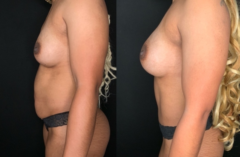 Patient #68942: Mommy Makeover Combine Image