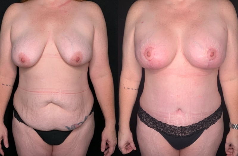 Patient #54677: Mommy Makeover Combine Image