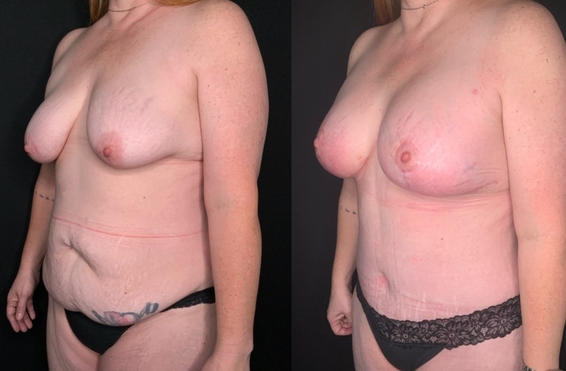 Patient #54677: Mommy Makeover Combine Image