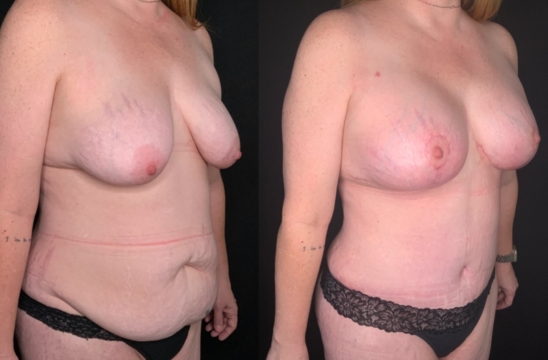 Patient #54677: Mommy Makeover Combine Image