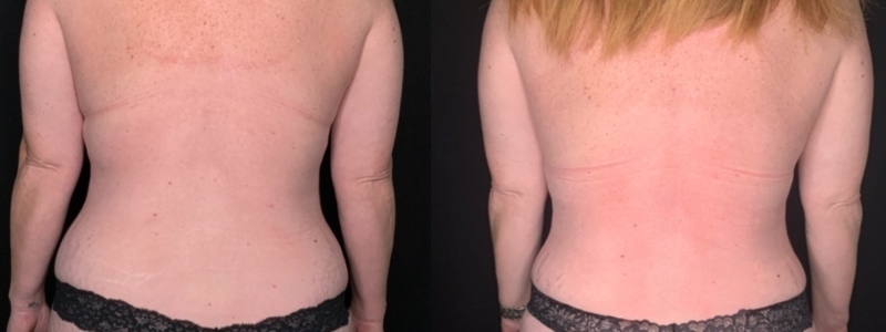 Patient #54677: Mommy Makeover Combine Image